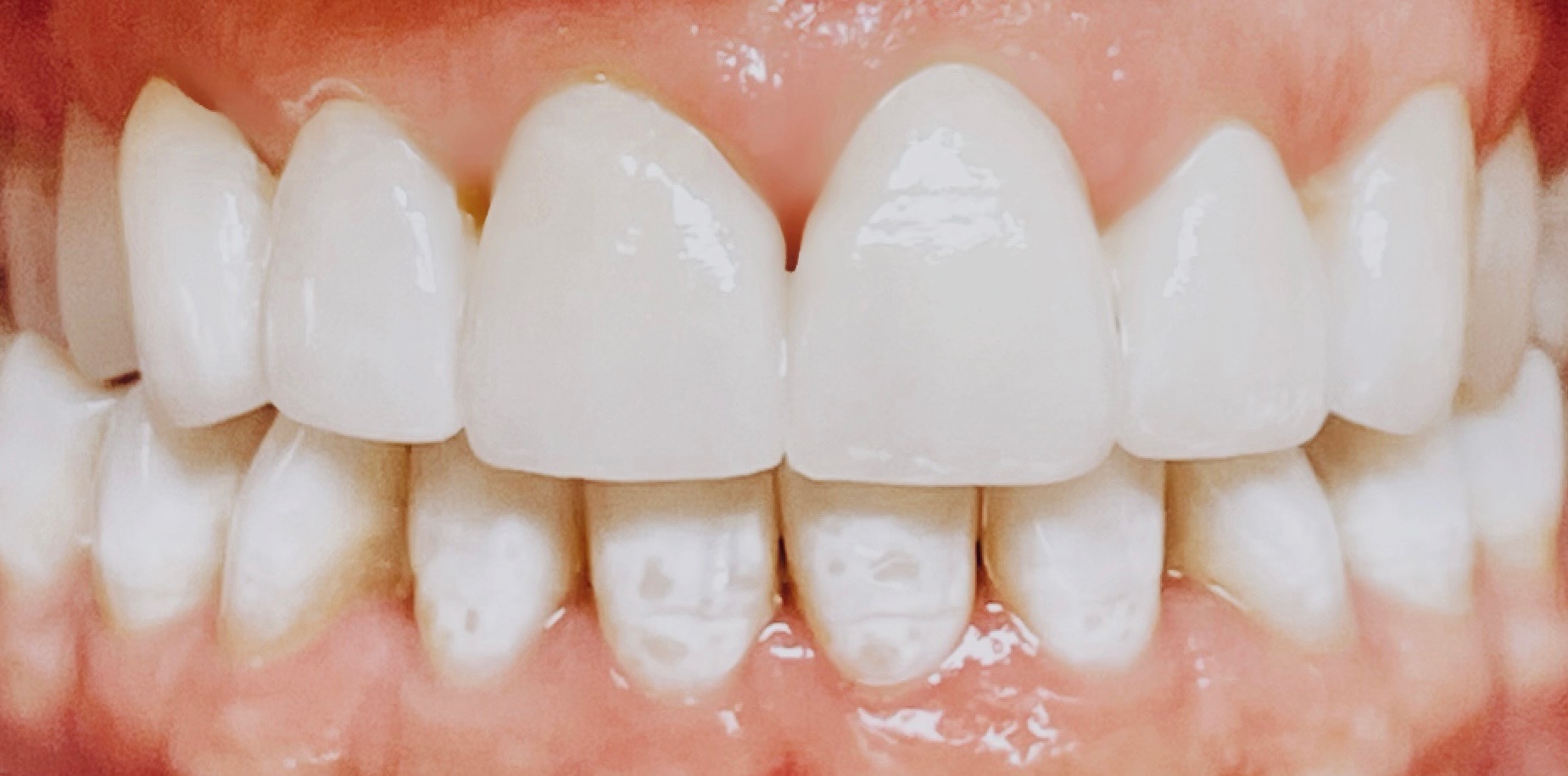 AZ Lifetime Dentistry | Dental Cleanings, Air Abrasion and Crowns  amp  Caps